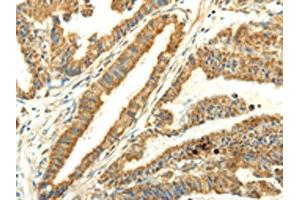 The image on the left is immunohistochemistry of paraffin-embedded Human esophagus cancer tissue using ABIN7128060(UBL4B Antibody) at dilution 1/25, on the right is treated with fusion protein. (UBL4B Antikörper)