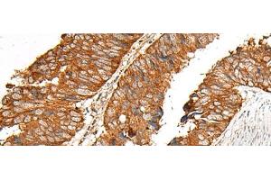 Immunohistochemistry of paraffin-embedded Human colorectal cancer tissue using MBOAT4 Polyclonal Antibody at dilution of 1:30(x200)