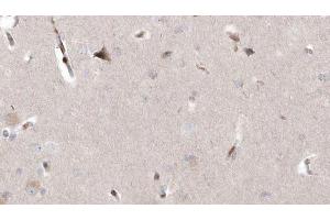 ABIN6273005 at 1/100 staining Human brain cancer tissue by IHC-P. (MAGT1 Antikörper  (Internal Region))
