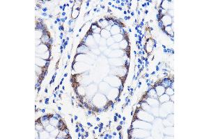 Immunohistochemistry of paraffin-embedded Human colon carcinoma using /// Rabbit pAb (ABIN7265627) at dilution of 1:50 (40x lens). (ANT1+ANT2+ANT3+ANT4 (C-Term) Antikörper)