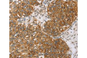 Immunohistochemistry of Human breast cancer using TPD52L2 Polyclonal Antibody at dilution of 1:35 (TPD52L2 Antikörper)