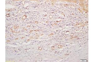 Formalin-fixed and paraffin embedded human liver carcinoma labeled with Rabbit Anti-CD4 Polyclonal Antibody, Unconjugated  at 1:200 followed by conjugation to the secondary antibody and DAB staining (CD4 Antikörper  (AA 301-400))