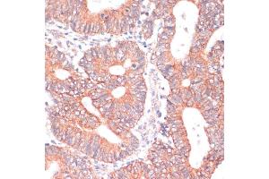 Immunohistochemistry of paraffin-embedded human colon carcinoma using TI antibody (ABIN6130725, ABIN6149146, ABIN6149147 and ABIN6214431) at dilution of 1:100 (40x lens). (TIAM1 Antikörper  (AA 1392-1591))