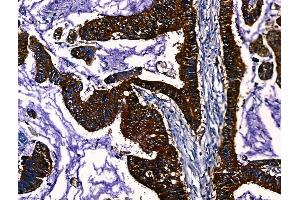 ABIN7094633 and ABIN7098683 at 1/100 staining Human liver cancer by IHC-P. (PGAM2 Antikörper  (Internal Region))
