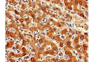 Immunohistochemistry of paraffin-embedded human liver cancer using ABIN7152571 at dilution of 1:100 (FDPS Antikörper  (AA 1-419))