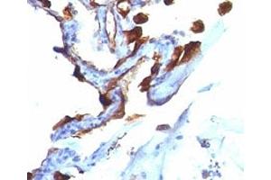 Formalin-fixed, paraffin-embedded human lung carcinoma stained with Cytokeratin 8 + 18 antibody (C-51). (Cytokeratin 8/18 Antikörper)
