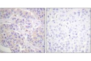 Immunohistochemistry analysis of paraffin-embedded human breast carcinoma tissue, using p130 Cas (Ab-165) Antibody. (BCAR1 Antikörper  (AA 131-180))