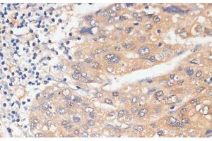 Immunohistochemistry of paraffin-embedded Human liver cancer using WNK3 Polyclonal Antibody at dilution of 1:100 (40x lens). (WNK3 Antikörper)