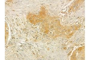 ABIN6264496 and ABIN6277636 at 1/100 staining human tongue carcinoma by IHC-P. (PSMF1 Antikörper  (C-Term))