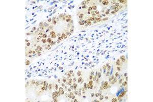 Immunohistochemistry of paraffin-embedded human colon carcinoma using MDC1 antibody at dilution of 1:100 (40x lens). (MDC1 Antikörper)
