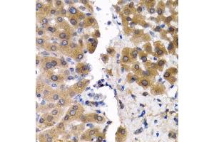 Immunohistochemistry of paraffin-embedded human liver cancer using SCP2 antibody. (SCP2 Antikörper)
