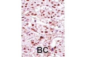 Formalin-fixed and paraffin-embedded human cancer tissue reacted with the primary antibody, which was peroxidase-conjugated to the secondary antibody, followed by DAB staining.