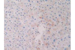 IHC-P analysis of Human Skin Cancer Tissue, with DAB staining. (CD63 Antikörper  (AA 103-203))