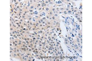 Immunohistochemistry of Human lung cancer using YWHAQ Polyclonal Antibody at dilution of 1:50 (14-3-3 theta Antikörper)