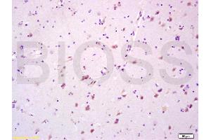 Formalin-fixed and paraffin embedded human glioma tissue labeled with Anti-CYP3A4 Polyclonal Antibody, Unconjugated (ABIN733793) at 1:200 followed by conjugation to the secondary antibody and DAB staining (CYP3A4 Antikörper  (AA 18-120))