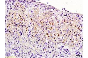 Formalin-fixed and paraffin embedded: rat uterine myoma labeled with Anti-PR (progesterone receptor) Polyclonal Antibody , Unconjugated 1:200 followed by conjugation to the secondary antibody and DAB staining (Progesterone Receptor Antikörper  (AA 501-600))