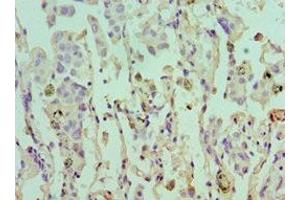 Immunohistochemistry of paraffin-embedded human lung cancer using ABIN7152105 at dilution of 1:100 (EIF4A1 Antikörper  (AA 167-406))