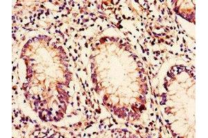 Immunohistochemistry of paraffin-embedded human colon cancer using ABIN7145632 at dilution of 1:100 (C10ORF32 Antikörper  (AA 2-105))