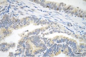 Immunohistochemistry was performed on paraffin-embedded human endometrial carcinoma using P70 S6 kinase beta antibody (ABIN7800226), 1:200). (Rekombinanter RPS6KB2 Antikörper)