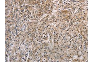 The image on the left is immunohistochemistry of paraffin-embedded Human gastic cancer tissue using ABIN7129403(ESRRG Antibody) at dilution 1/30, on the right is treated with fusion protein. (ESRRG Antikörper)