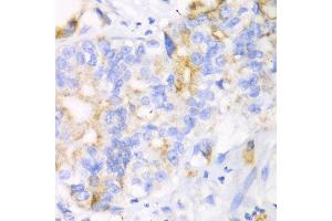 Immunohistochemistry of paraffin-embedded human liver cancer using CHIA antibody at dilution of 1:100 (x40 lens). (CHIA Antikörper)