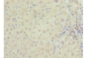 Immunohistochemistry of paraffin-embedded human liver cancer using ABIN7167252 at dilution of 1:100 (RAB23 Antikörper  (AA 1-237))
