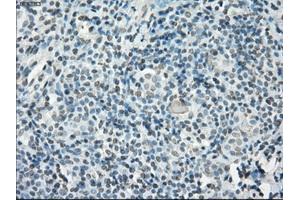 Immunohistochemical staining of paraffin-embedded Adenocarcinoma of ovary tissue using anti-PORmouse monoclonal antibody. (POR Antikörper)