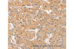 Immunohistochemistry of Human liver cancer using SMOC2 Polyclonal Antibody at dilution of 1:35 (SMOC2 Antikörper)