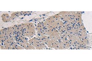 Immunohistochemistry of paraffin-embedded Human gastric cancer tissue using COL17A1 Polyclonal Antibody at dilution of 1:50(x200) (COL17A1 Antikörper)