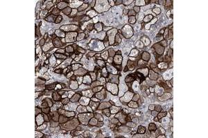 Immunohistochemical staining of human adrenal gland with SLC43A2 polyclonal antibody  shows strong cytoplasmic and membranous positivity in cortical cells.