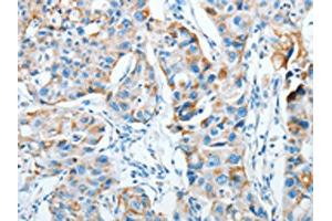 The image on the left is immunohistochemistry of paraffin-embedded Human breast cancer tissue using ABIN7128282(AGA Antibody) at dilution 1/20, on the right is treated with fusion protein. (AGA Antikörper)