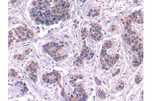DAB staining on IHC-P; Samples: Human Liver cancer Tissue (Complement C4 Antikörper  (AA 975-1336))