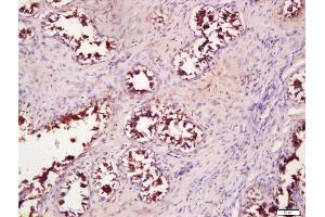 Formalin-fixed and paraffin embedded human breast carcinoma labeled with Anti-WNT4 Polyclonal Antibody, Unconjugated (ABIN762911) at 1:200 followed by conjugation to the secondary antibody and DAB staining