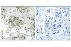 Immunohistochemistry analysis of paraffin-embedded human breast carcinoma tissue, using USP13 antibody. (USP13 Antikörper)