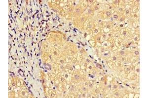 Immunohistochemistry of paraffin-embedded human liver cancer using ABIN7151414 at dilution of 1:100 (EFCAB7 Antikörper  (AA 1-158))