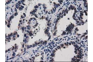Immunohistochemical staining of paraffin-embedded Carcinoma of Human thyroid tissue using anti-HDHD1A mouse monoclonal antibody. (HDHD1 Antikörper)
