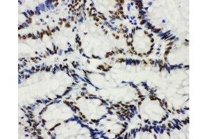 Anti-HDAC3 antibody,  IHC(P) IHC(P): Human Intestinal Cancer Tissue (HDAC3 Antikörper  (C-Term))