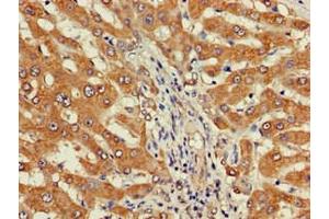 Immunohistochemistry of paraffin-embedded human liver cancer using ABIN7149738 at dilution of 1:100