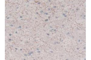 IHC-P analysis of Human Glioma Tissue, with DAB staining. (IL-8 Antikörper  (AA 23-101))