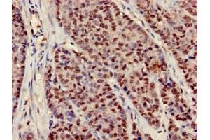 Immunohistochemistry of paraffin-embedded human ovarian cancer using ABIN7151782 at dilution of 1:100 (NEDD9 Antikörper  (AA 68-151))