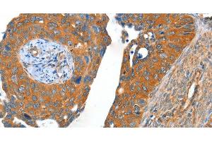 Immunohistochemistry of paraffin-embedded Human cervical cancer using ACOT11 Polyclonal Antibody at dilution of 1:40 (ACOT11 Antikörper)
