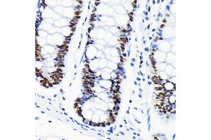 Immunohistochemistry of paraffin-embedded human colon using Chk2 antibody (ABIN7266294) at dilution of 1:100 (40x lens). (CHEK2 Antikörper)