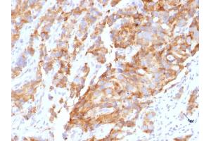 Formalin-fixed, paraffin-embedded human Prostate Carcinoma stained with Aurora B Mouse Monoclonal Antibody (AURKB/1592). (Aurora Kinase B Antikörper  (AA 89-251))
