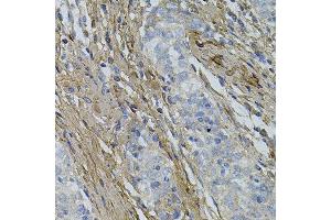 Immunohistochemistry of paraffin-embedded human esophageal cancer using COL1A1 antibody. (COL1A1 Antikörper)