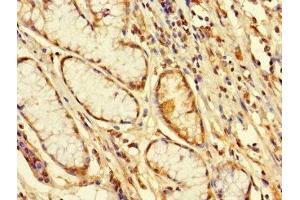 Immunohistochemistry of paraffin-embedded human gastric cancer using ABIN7152491 at dilution of 1:100 (FBXW12 Antikörper  (AA 1-250))