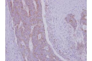 IHC-P Image Immunohistochemical analysis of paraffin-embedded human colon carcinoma, using RRM1, antibody at 1:500 dilution. (RRM1 Antikörper  (Center))