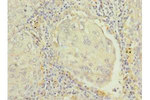 Immunohistochemistry of paraffin-embedded human lung cancer using ABIN7167399 at dilution of 1:100 (RAP1B Antikörper  (AA 1-181))