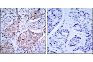 Immunohistochemistry analysis of paraffin-embedded human breast carcinoma, using HER2 (Phospho-Tyr1221/Tyr1222) Antibody. (ErbB2/Her2 Antikörper  (pTyr1221))