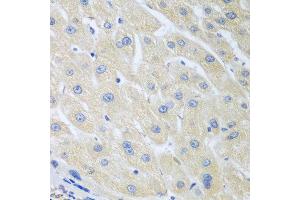 Immunohistochemistry of paraffin-embedded human liver cancer using PON1 antibody at dilution of 1:100 (40x lens). (PON1 Antikörper)
