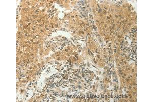 Immunohistochemistry of Human lung cancer using SLC8A3 Polyclonal Antibody at dilution of 1:70 (SLC8A3 Antikörper)